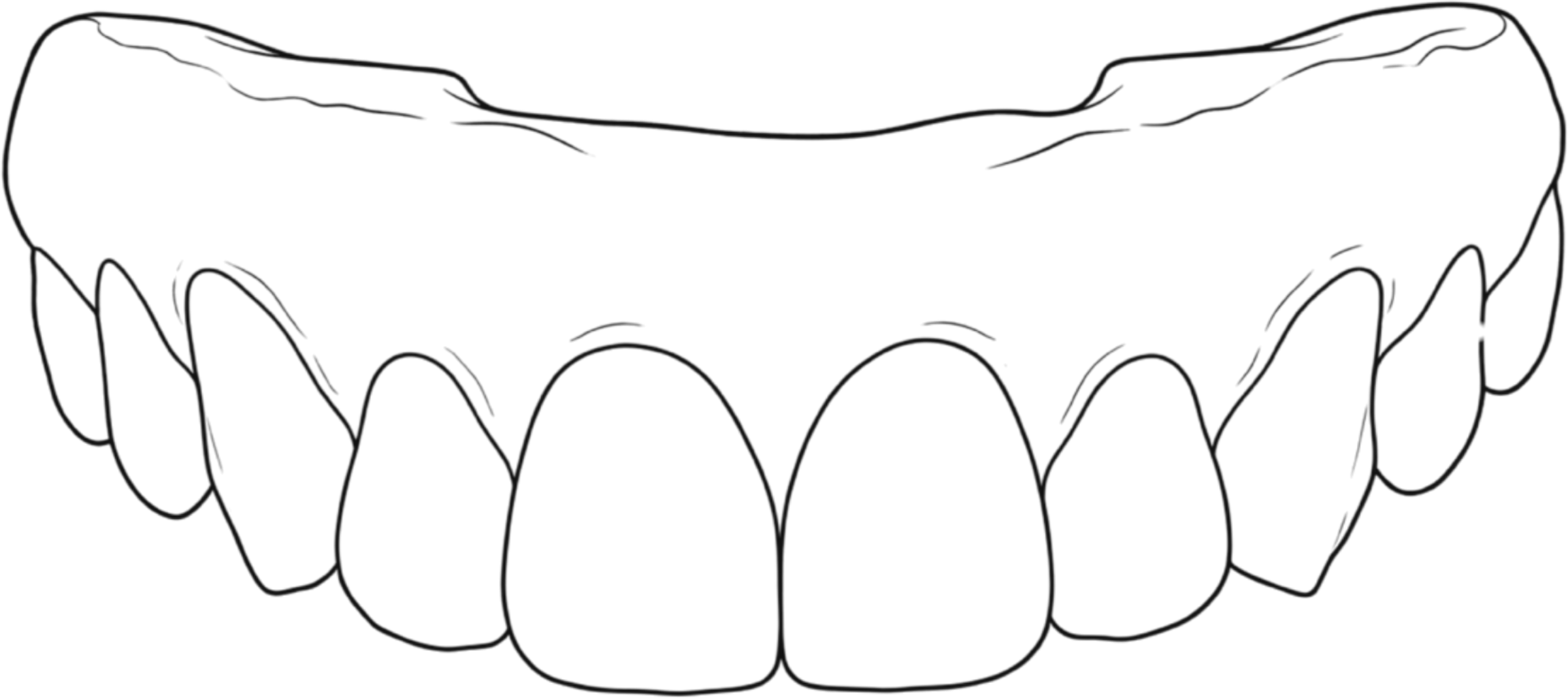 Line drawing of a full-arch prosthesis