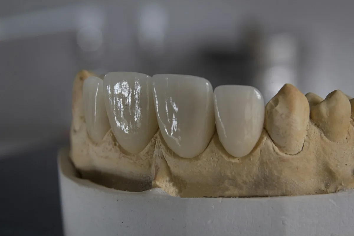Anterior crowns seated on a stone model